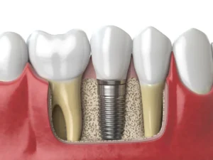 anatomy of healthy teeth and tooth dental implant 2023 11 27 05 23 40 utc