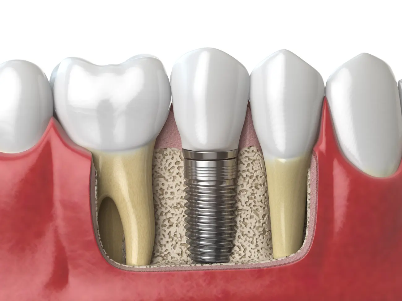 anatomy of healthy teeth and tooth dental implant 2023 11 27 05 23 40 utc